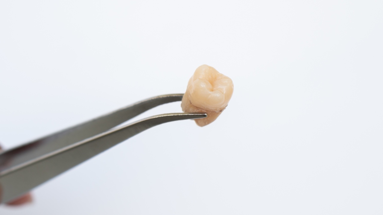 押上の親知らずの抜歯・治療