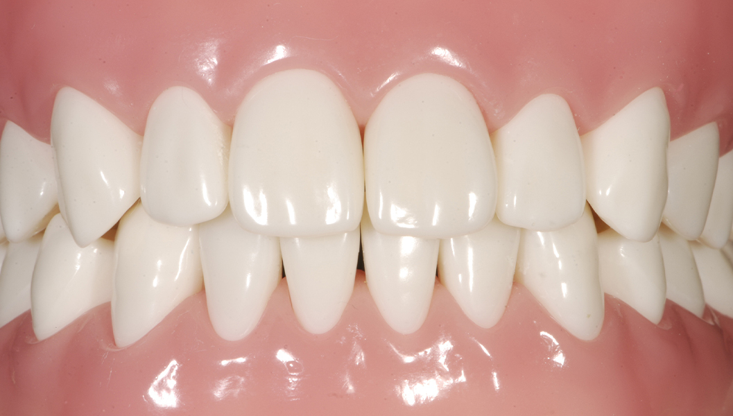 押上のセラミック治療