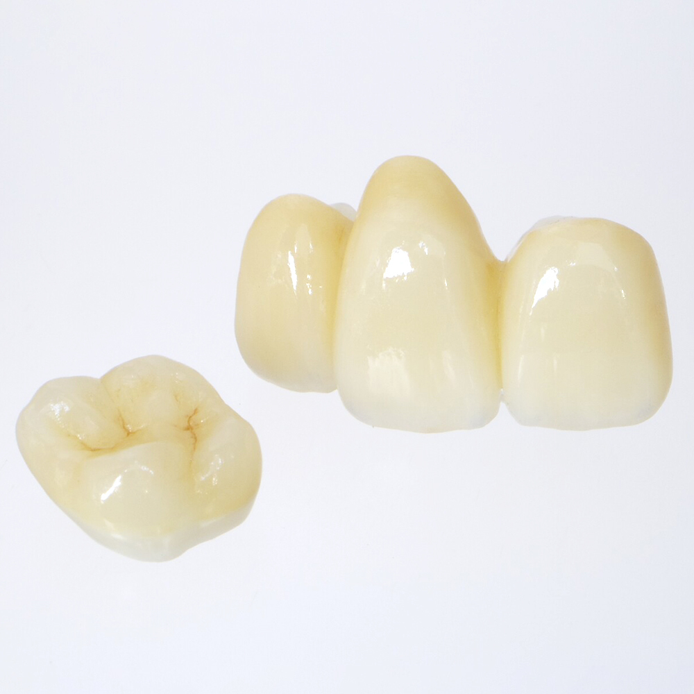 押上の保険の白い歯（CAD/CAM冠）