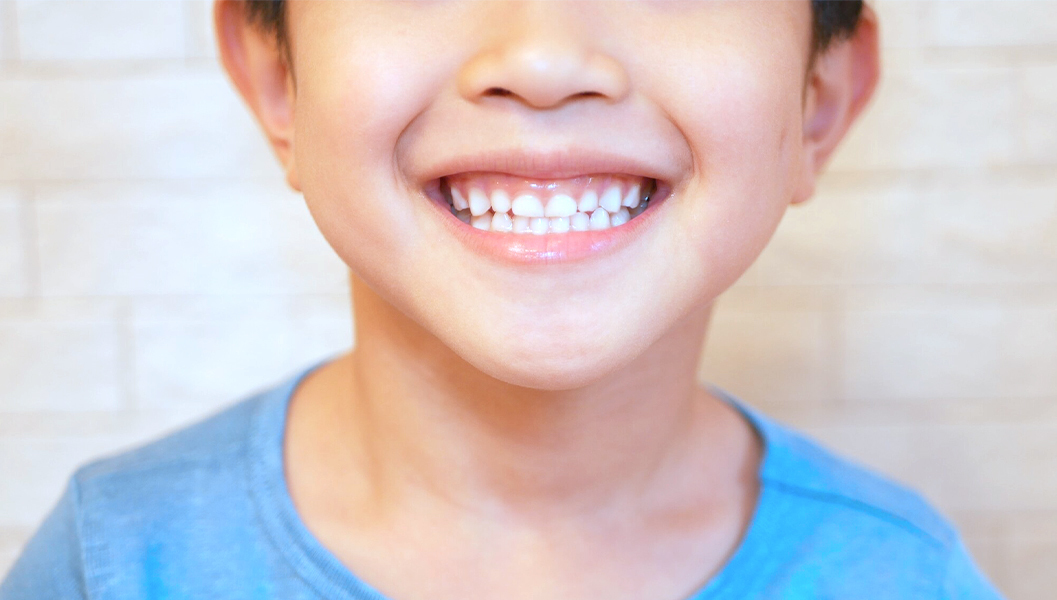 押上のシーラント