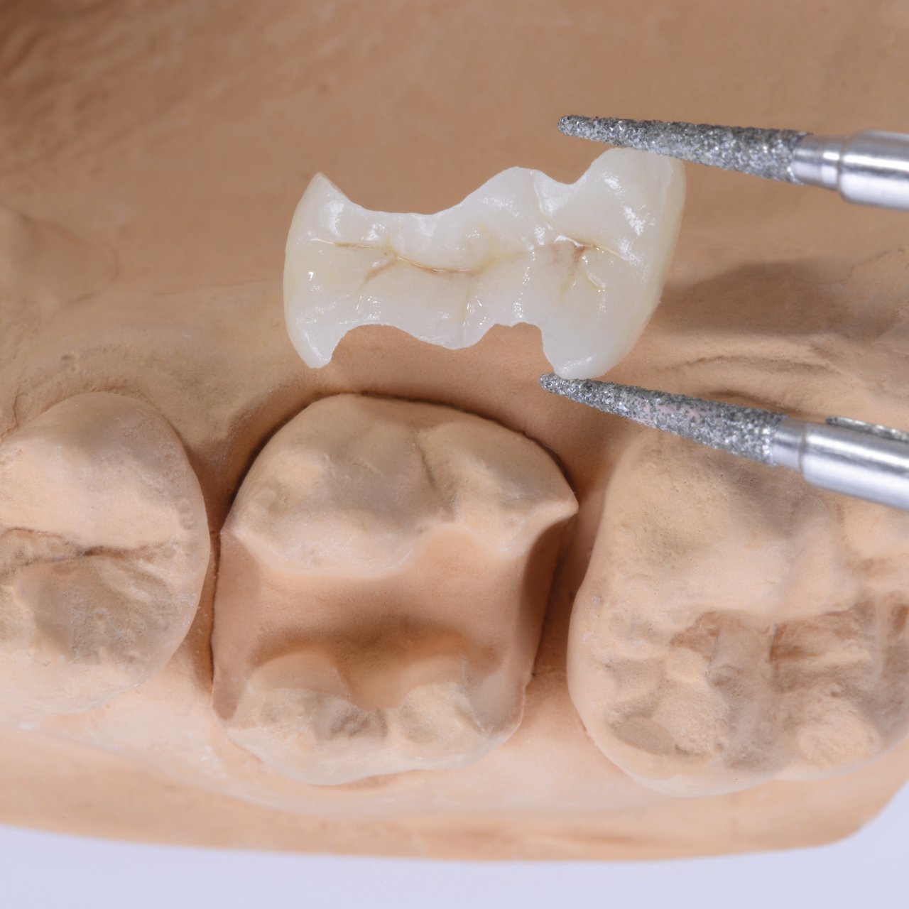 押上のなるべく歯を削らない治療