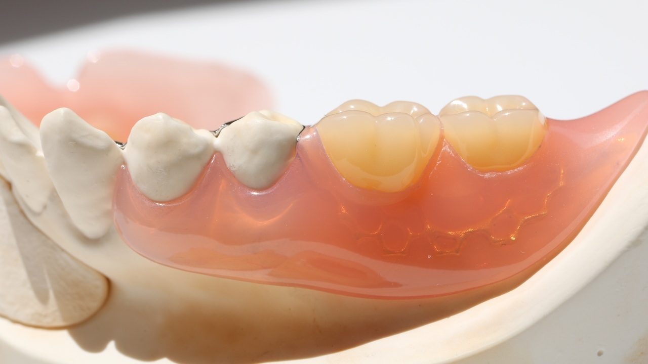 押上のノンクラスプデンチャー