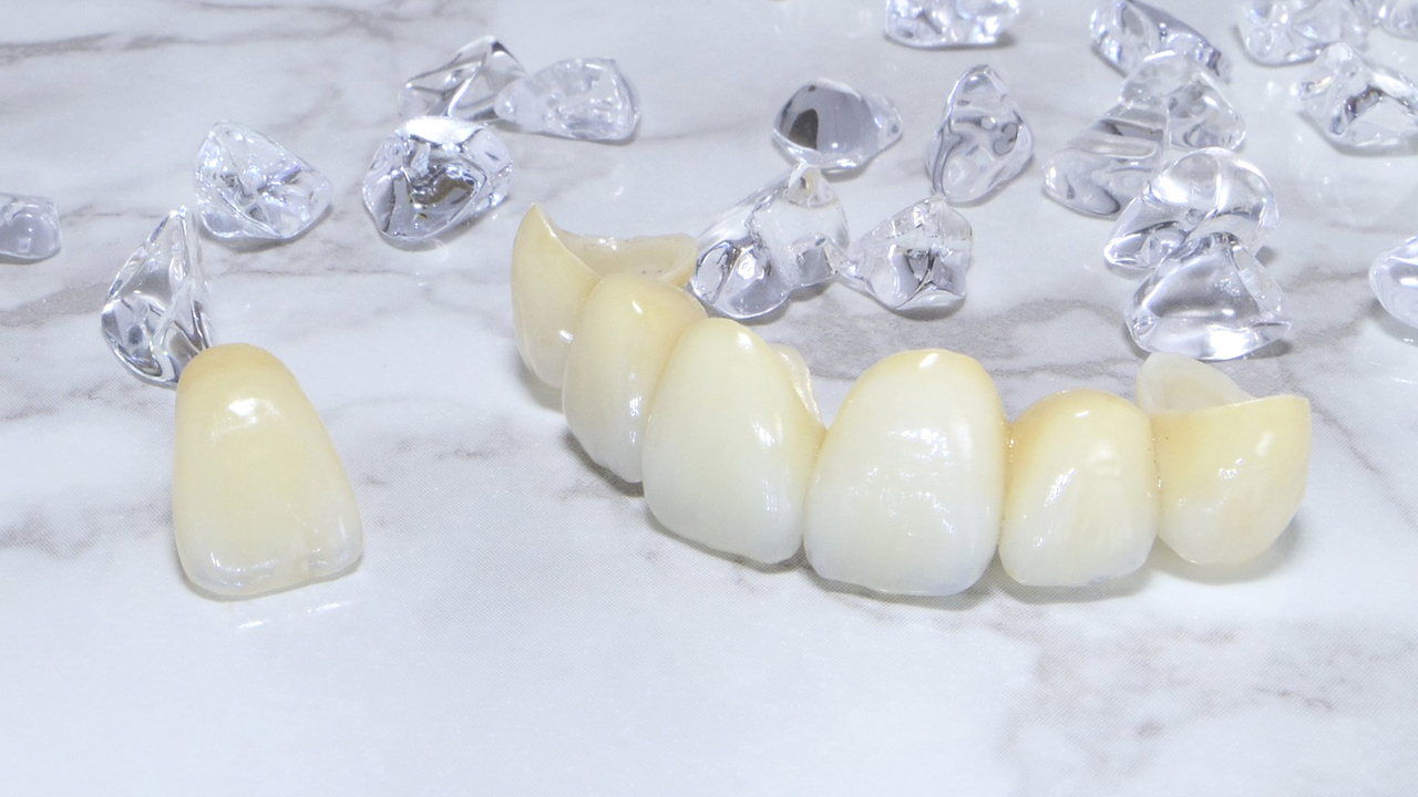 押上のセラミック治療