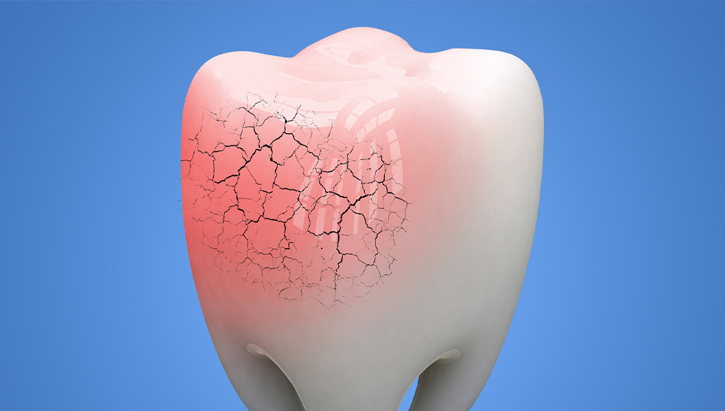 押上で歯ぎしり改善｜ナイトガードを使った治療