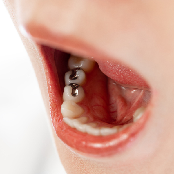 押上のなるべく歯を削らない治療