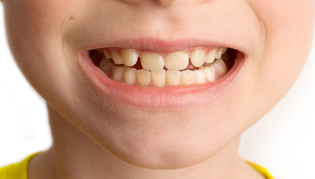 押上の小児の予防歯科