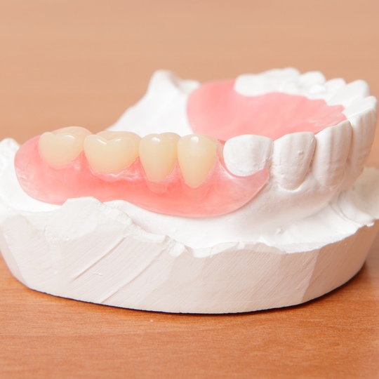 押上のノンクラスプデンチャー