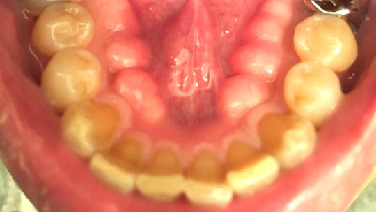 押上で歯ぎしり改善｜ナイトガードを使った治療