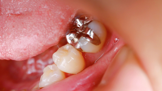 押上のなるべく歯を削らない治療