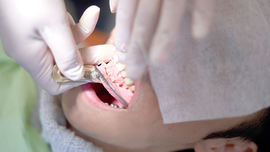 押上のマウスガード（スポーツ用マウスガード）