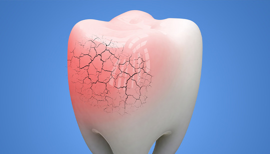 押上で歯ぎしり改善｜ナイトガードを使った治療
