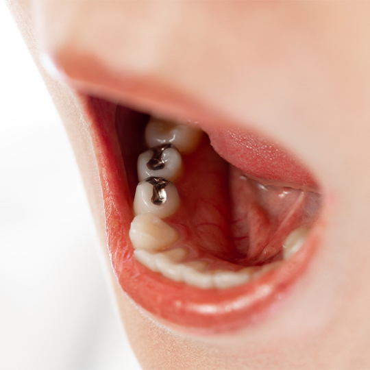 押上のなるべく歯を削らない治療